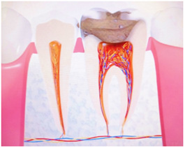C2:象牙質に達した虫歯