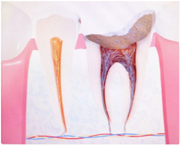 C3:歯髄（神経）に達した虫歯
